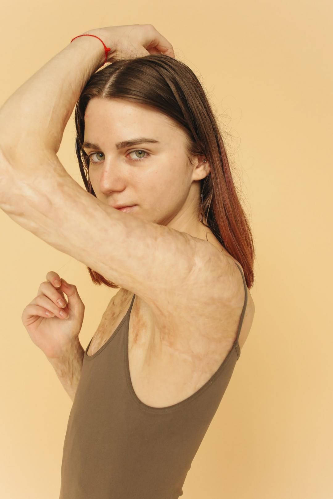 A woman with scarring on her body.